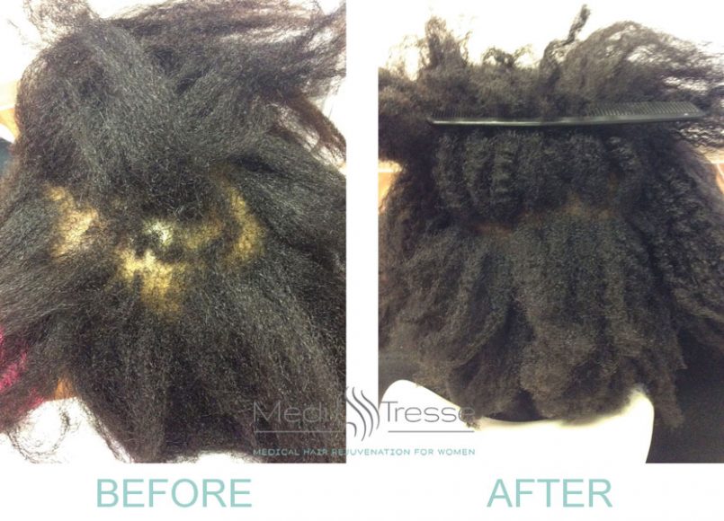 Before and after being treated with PRP therapy. Courtesy Medi Tresse.