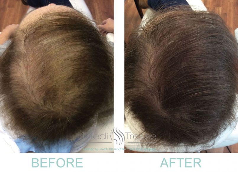 Before and after being treated with PRP therapy. Courtesy Medi Tresse.