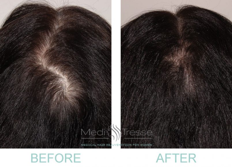 Before and after being treated with PRP and Low Level Laser therapy. Courtesy Medi Tresse.