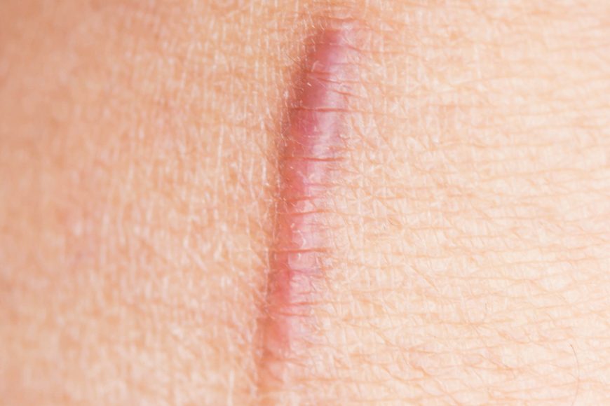 Once permanent marks, scars are now being minimized and even eliminated with new treatments.